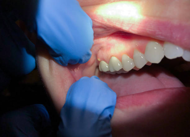 Best Emergency Dental Care for Broken or Chipped Teeth in Berthoud, CO